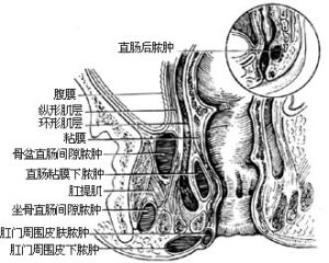 直腸肛管周圍膿腫
