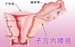 子宮內膜腫瘤