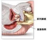 肛門直腸疾病