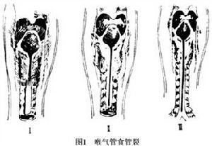 喉氣管食管裂