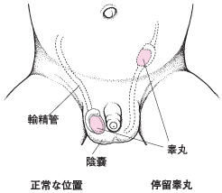 特發性低促性腺激素性性腺功能減退症