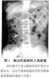 蛔蟲性腸梗阻