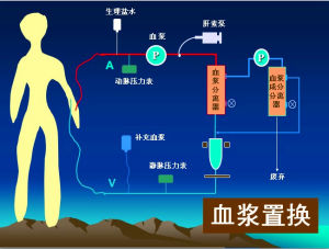 血漿置換治療示意圖