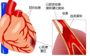 老年人甲減性心臟病