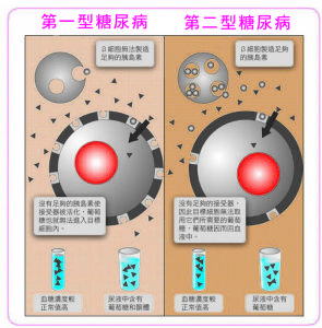 1型糖尿病和2型糖尿病區別