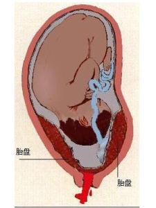 完全性前置胎盤