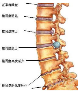 腰椎間盤突出症