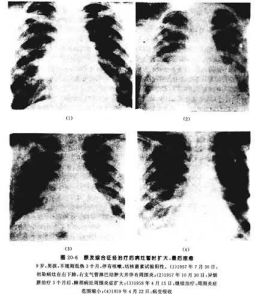 腎上腺皮質功能異常伴發的精神障礙