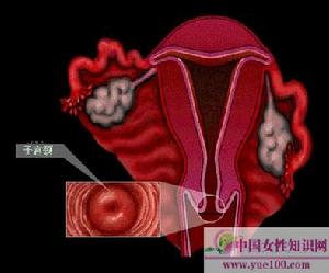 外陰惡性腫瘤