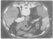 原發性腹膜癌