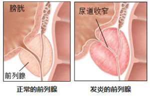 男性小腹墜痛