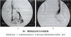 髂靜脈壓迫綜合徵