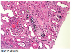 急性腎損傷