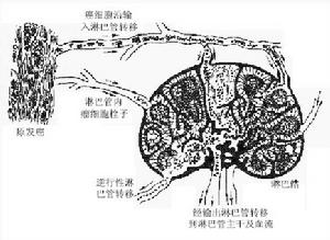 非感染性心內膜炎