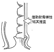 鼻中隔偏曲