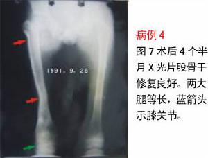 股骨大粗隆結核