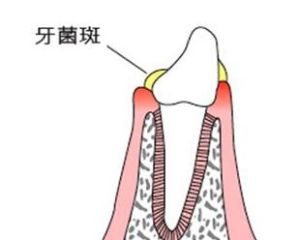 牙菌斑