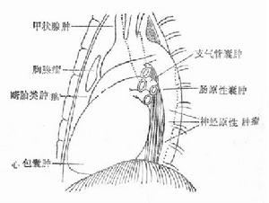 心包囊腫