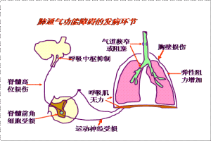 肺性腦病