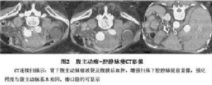 腹主動脈腔靜脈瘺