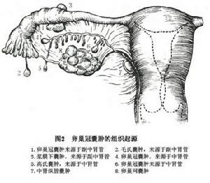 卵巢冠囊腫