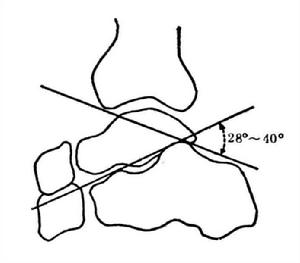 跟骨結節關節角