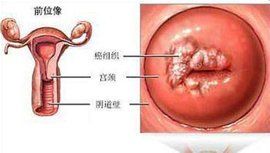 HPV分型