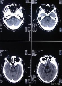 遺傳性多發腦梗死性痴呆