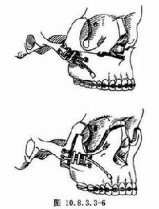 雙側牽張成骨下頜骨前徙術