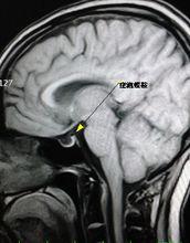 空泡蝶鞍MRI矢狀面