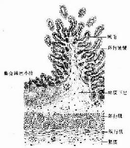 原發性小腸淋巴管擴張症