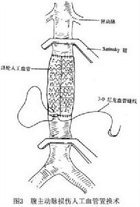 腹部大血管損傷