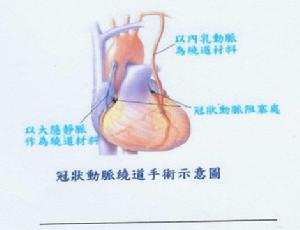 心臟損傷