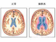 高顱壓性腦積水