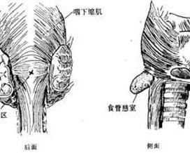 食管中段憩室