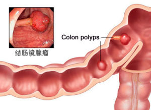 腺瘤