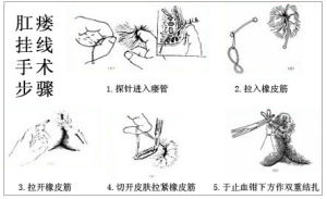 肛瘺掛線手術