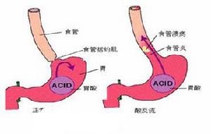 食管下括約肌