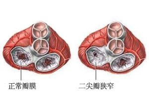 二尖瓣狹窄