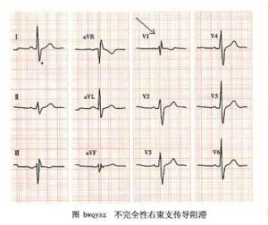 束支傳導阻滯