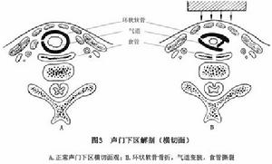 喉部鈍挫傷