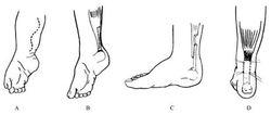 跟腱攣縮臨床表現