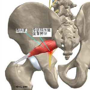 腰腿痛梨狀肌損傷綜合症