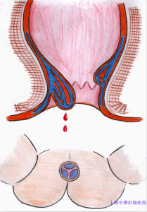 痔瘡出血示例圖