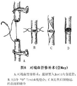 頸部血管損傷