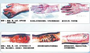 全身化膿性感染