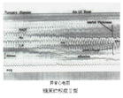 糖原貯積病Ⅱ型