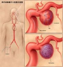 升主動脈瘤