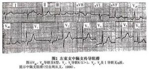 左束支中隔支傳導阻滯