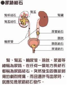 上尿路結石